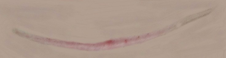 Better Beauty Vermont C-section scar